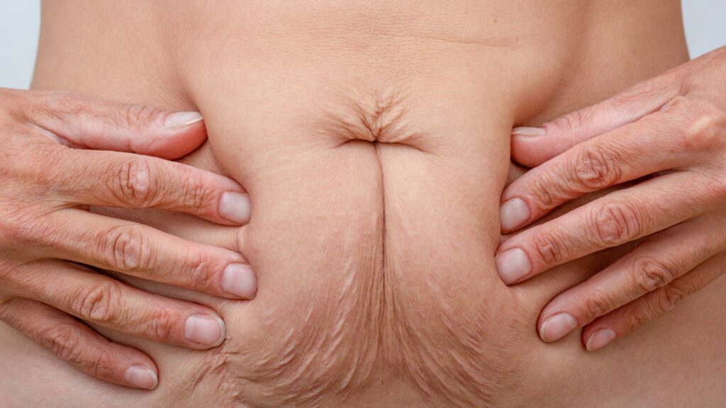 Descubra como o ArgoPlasma pode combater flacidez e cicatrizes