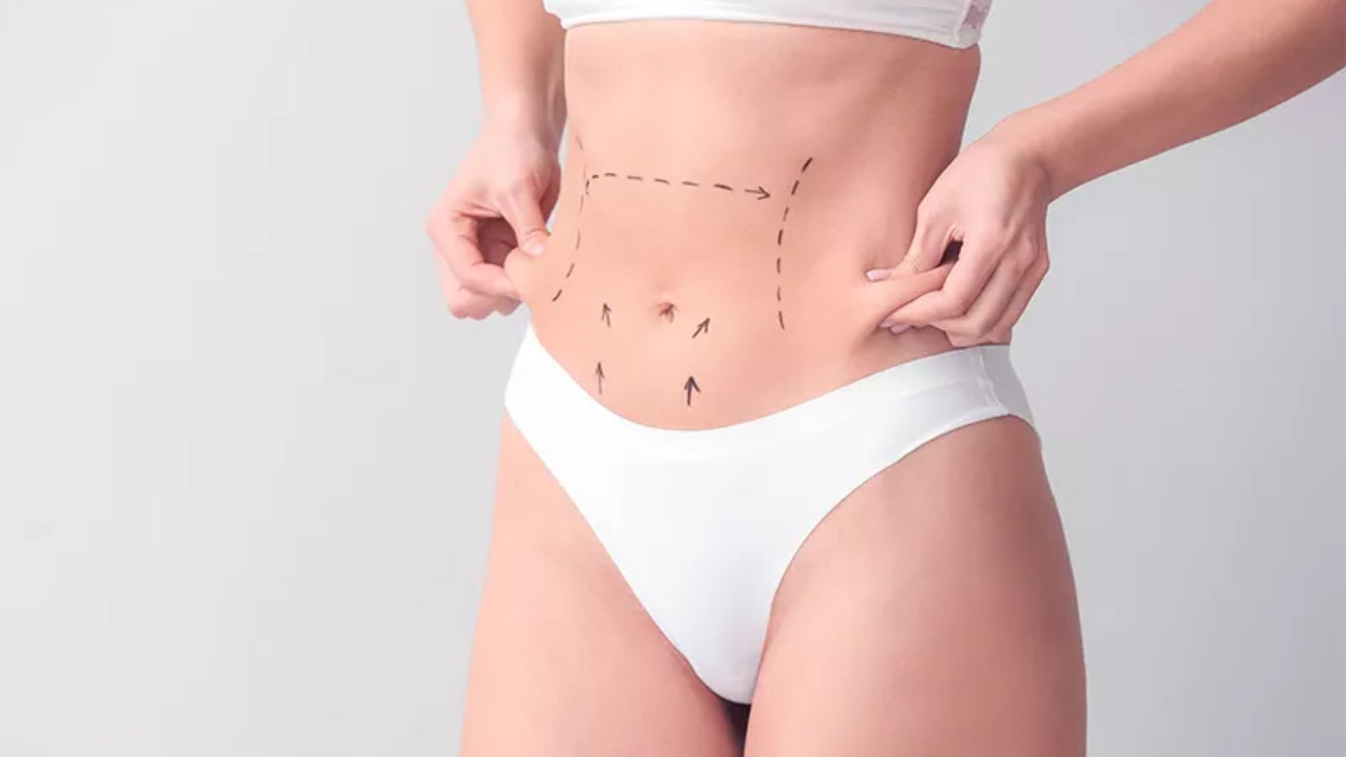 Descubra a lipoaspiração com Renuvion: técnica inovadora que une remoção de gordura e firmeza da pele para resultados surpreendentes e recuperação rápida.