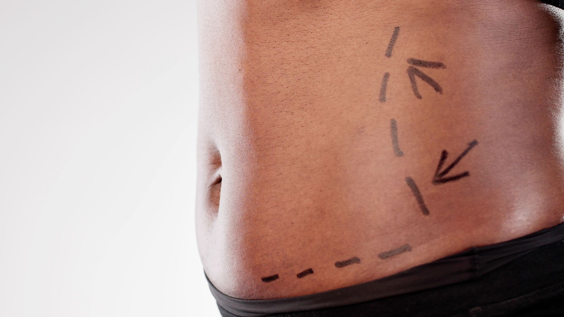 Descubra as diferenças entre abdominoplastia e lipoabdominoplastia e saiba qual procedimento é ideal para você. Melhore sua autoestima!
