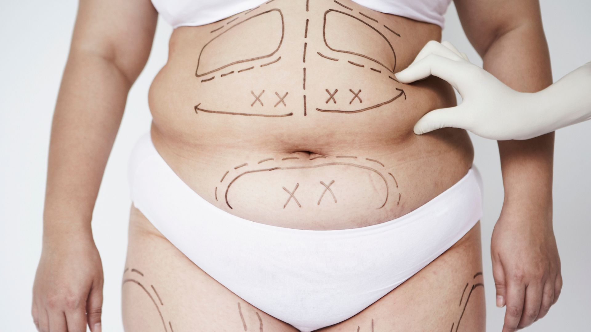 Descubra as técnicas de lipoaspiração: tradicional