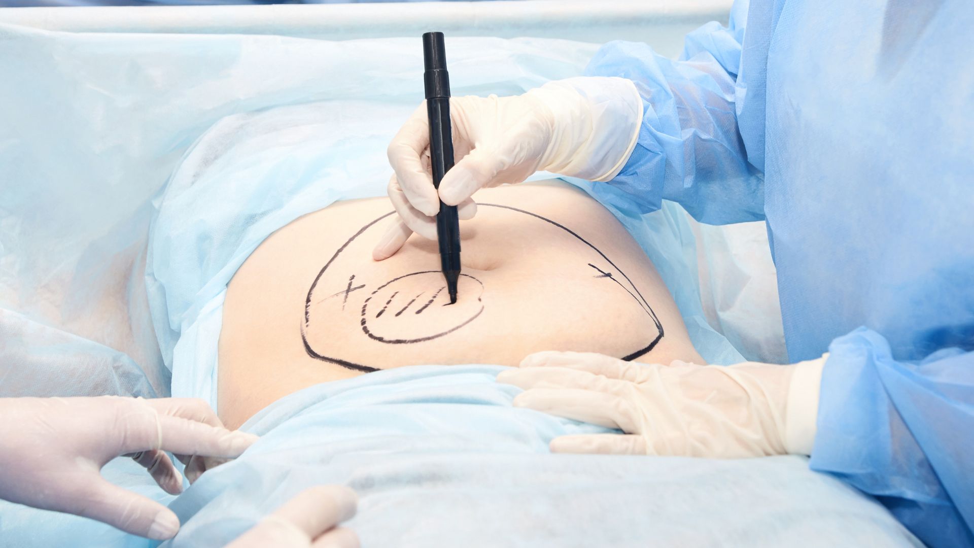 Descubra como as cicatrizes de lipoaspiração e próteses evoluem com o tempo e aprenda a cuidá-las adequadamente para uma recuperação tranquila.